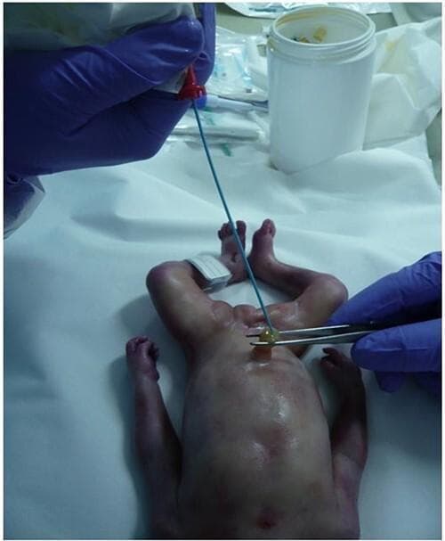 This clinical photograph demonstrates the procedure of umbilical vein catheterization in a newborn in a post-mortem clinical setting. The infant is positioned supine on a sterile white drape, exhibiting skin findings of pallor, generalized mottling, and peripheral cyanosis of the hands and feet. A gloved healthcare provider uses surgical forceps to stabilize the umbilical cord stump while inserting a 5 French radiological sheath (thin blue catheter) into the umbilical vein. The catheter is equipped with a red proximal adapter for the administration of contrast media, such as Angiofil, to facilitate post-mortem computed tomography angiography (PMCTA). This procedure is part of a forensic or diagnostic investigation to visualize the vascular system and evaluate for anomalies, such as those associated with hydranencephaly. The image captures key anatomical landmarks including the umbilical cord and the abdominal wall, highlighting the technique for establishing vascular access in neonatal pathology.