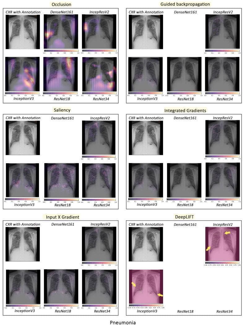 A multi-panel comparison chart illustrating various artificial intelligence (AI) interpretability techniques applied to Chest X-ray (CXR) images for pneumonia detection. The chart evaluates six local interpretability methods: Occlusion, Guided Backpropagation, Saliency, Integrated Gradients, Input X Gradient, and DeepLIFT. Each section includes a baseline 'CXR with Annotation' showing expert-identified pathology zones alongside heatmaps or saliency maps from five neural network architectures: DenseNet161, InceptionResNetV2, InceptionV3, ResNet18, and ResNet34. The heatmaps use color gradients (yellow to purple) to indicate regions of interest that influenced the model's classification. The visualizations demonstrate significant variability in model focus; for instance, the Occlusion method shows concentrated highlighting in the lower lung fields for ResNet models, while InceptionV3 exhibits more diffuse, high-intensity regions across the lungs. Other methods like DeepLIFT and Saliency display more granular, pixel-level importance. This comparison serves to evaluate the clinical validity of AI decision-making by comparing model-highlighted 'important' features against human-annotated radiological signs of pneumonia.