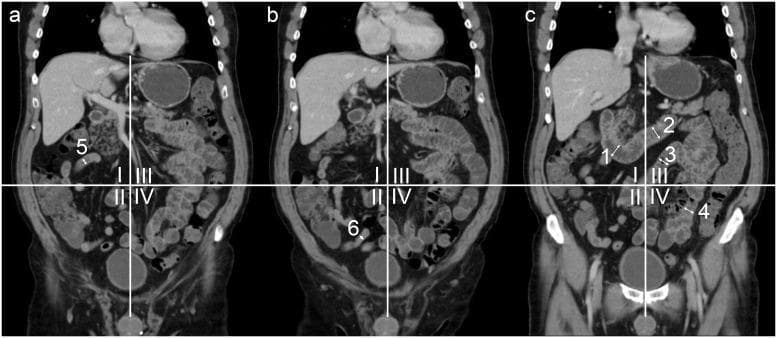 Three consecutive coronal reformatted CT slices (a, b, c) of a human abdomen and pelvis, illustrating a standardized anatomical classification of small bowel segments. The abdomen is partitioned into four quadrants (I–IV) by a vertical midline and a horizontal line intersecting at the umbilicus. The imaging demonstrates the localization of specific bowel segments: (1) descending duodenum, (2) horizontal duodenum, (3) proximal jejunum in the upper left quadrant (III), (4) distal jejunum in the lower left quadrant (IV), (5) proximal ileum in the upper right quadrant (I), and (6) distal ileum in the lower right quadrant (II). The images show typical contrast-enhanced visceral organs including the liver, spleen, kidneys, and urinary bladder. The diagnostic focus is on defining regional bowel anatomy for clinical evaluation of luminal distension and localization of pathology using a quadrant-based model.
