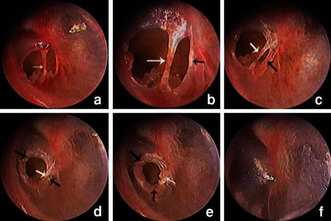 This series of six otoendoscopic images (a–f) illustrates the chronological stages of spontaneous tympanic membrane healing over a 49-day period. The initial images (a, b) show a traumatic eardrum perforation bisected by an 'eardrum bridge' (white arrow), which is a strip of intact tissue spanning the defect. Subsequent frames (c–e) document the process of stratified epithelial migration. Proliferating epithelium at the perforation margins (black arrows) is seen moving centripetally to close the gap. During this progression, the eardrum bridge serves as a scaffold; it gradually incorporates into the regenerating tissue or is replaced by newly formed epithelium. By day 49 (f), the perforation has achieved complete closure, the eardrum bridge is no longer a distinct structure, and the tympanic membrane shows a restored, uniform surface with minor residual scarring. This series demonstrates key concepts in otolaryngology, specifically the natural history of traumatic perforation repair and the role of epithelial hyperplasia in secondary intention healing of the tympanic membrane.