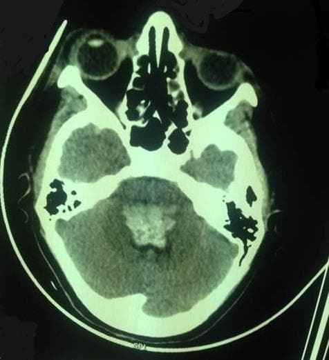 This diagnostic image is an axial non-contrast computerized tomography (CT) scan of the head at the level of the posterior fossa. The image displays the skull base, temporal bones, orbits, and paranasal sinuses. Key anatomical structures visible include the cerebellum and the brainstem (pons/medulla region). A significant abnormal finding is a centrally located, hyperdense area within the brainstem, consistent with an acute bulbo-protuberantial hematoma. The lesion measures approximately 32 x 21 x 29 mm and exerts a noticeable mass effect, resulting in the compression and effacement of the surrounding basal cisterns. The density variations clearly differentiate the high-attenuation bone of the skull, the intermediate-attenuation brain parenchyma, and the low-attenuation fluid within the remaining subarachnoid spaces. This clinical imaging is illustrative of severe neurological complications associated with conditions such as eclampsia, emphasizing the critical role of neuroimaging in evaluating sudden neurological deterioration in obstetric patients.