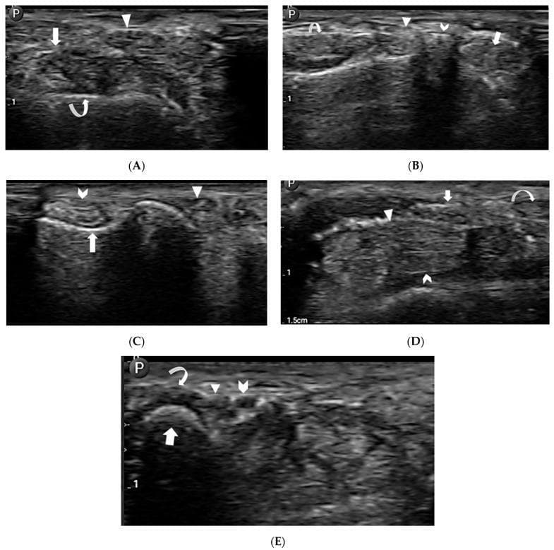 A series of five musculoskeletal ultrasound (MSKUS) images (A-E) demonstrating the transverse cross-sectional anatomy of the wrist's extensor compartments, carpal tunnel, and Guyon's canal. (A) Shows the radial aspect with the first extensor compartment (arrow), third extensor compartment (arrowhead), and the hyperechoic cortex of the radial styloid process (curved arrow). (B) Visualizes the second (arrow), third (arrowhead), and fourth (curved arrow) extensor compartments adjacent to Lister’s tubercle (chevron). (C) Displays the ulnar side including the fifth (arrowhead) and sixth (chevron) extensor compartments, with the distal ulnar groove (arrow). (D) Focuses on the carpal tunnel, identifying the median nerve (arrow), flexor digitorum superficialis (arrowhead), flexor digitorum profundus (chevron), and flexor carpi radialis (curved arrow). (E) Illustrates Guyon's canal containing the ulnar artery (chevron), ulnar nerve (arrowhead), and flexor carpi ulnaris tendon (curved arrow) superior to the triquetrum bone (arrow). The images utilize annotations to highlight variations in echogenicity and spatial relationships between tendons, nerves, and bony landmarks for diagnostic and interventional mapping.