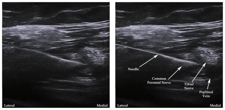 Two side-by-side ultrasound images demonstrate a regional anesthesia technique for a popliteal fossa nerve block. The diagnostic images show a transverse cross-section of the posterior knee anatomy. The left image is unannotated, while the right image includes labels and pointers for anatomical orientation. From a lateral to medial orientation, the hyperechoic structures identified include the Common Peroneal Nerve and the Tibial Nerve. Further medial and deep is the Popliteal Vein, appearing as a more hypoechoic vascular structure. A linear, hyperechoic needle is visible entering from the lateral aspect using an in-plane approach, with its tip directed toward the space between the Common Peroneal and Tibial nerves. This visual serves as an educational guide for ultrasound-guided peripheral nerve blocks, illustrating the target nerves' relationship to vascular landmarks and the proper needle trajectory to avoid vascular puncture while ensuring anesthetic deposition near the sciatic nerve bifurcation.