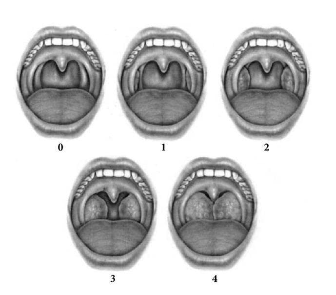 This Comparison Chart illustrates the Brodsky Grading Scale for tonsillar hypertrophy, a clinical assessment tool used in otolaryngology. The diagram features five grayscale anatomical illustrations of the open mouth and oropharynx, labeled 0 through 4, depicting the progressive obstruction of the pharyngeal space by the palatine tonsils. Key anatomical landmarks shown include the tongue, uvula, soft palate, and anterior tonsillar pillars. Grade 0 shows no visible tonsillar tissue (post-tonsillectomy). Grade 1 depicts tonsils confined within the tonsillar pillars (occupying <25% of the transverse oropharyngeal diameter). Grade 2 shows tonsils extending beyond the pillars, occupying 25%–50% of the space. Grade 3 demonstrates tonsils occupying 51%–75% of the space, significantly narrowing the airway. Grade 4 shows tonsils occupying >75% of the space, nearly meeting or touching at the midline (often called 'kissing tonsils'). This visual serves as an educational standard for diagnosing obstructive sleep apnea and planning surgical intervention in both pediatric and adult populations.