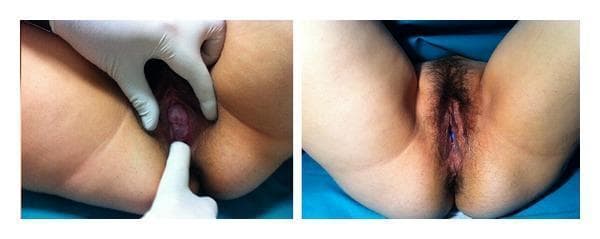 A side-by-side clinical photograph documenting uterine prolapse and its subsequent management with a pessary in a pregnant patient. The left panel shows a clinical examination of the vulva with a gloved hand retracting the labia. The cervix is visibly descended and protruding through the vaginal introitus, characteristic of grade 2 pelvic organ prolapse. The cervical tissue appears hyperemic and edematous. The right panel displays the external female genitalia following the placement of an Arabin cerclage pessary. In this view, the prolapse is reduced, and a portion of the blue silicone pessary is visible within the vaginal canal, positioned to support the cervix and maintain its placement. The image illustrates a non-surgical management strategy for symptomatic uterine prolapse and acute urinary retention during pregnancy. Educational concepts include pelvic floor anatomy, grading of organ prolapse, and mechanical support devices in obstetrics and gynecology.