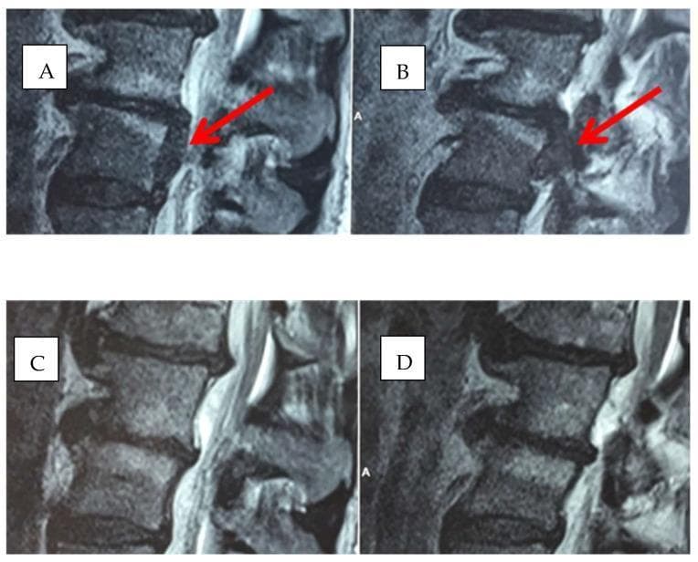 Diagnostic sagittal and axial magnetic resonance imaging (MRI) of the lumbar spine, specifically focusing on the L4-L5 segment. Images A and B represent the baseline state, demonstrating a focal posterior disc herniation (indicated by red arrows) that causes significant encroachment on the neural foramen and potential compression of the traversing nerve root. The intervertebral disc at L4-L5 shows a distinct protrusion beyond the vertebral margins. Images C and D are follow-up scans of the same anatomical region after oxygen-ozone and nutraceutical treatment (ALA, PEA, Myrrh). These post-treatment images show a significant reduction in the size and protrusion of the herniated disc material. The neural foramen appears more patent, with restored epidural fat space and improved alignment of the posterior disc margin. This comparison illustrates the radiological resolution of lumbar disc herniation and the decompression of associated spinal neural structures over time.