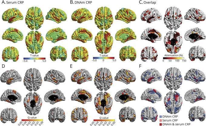 This composite diagnostic image presents neuroimaging data analyzing the association between C-reactive protein (CRP) measures and regional brain cortical volume. It features several panels of brain surface reconstructions in lateral, dorsal, ventral, and sagittal views. Panels A and B display T-maps for Serum CRP and DNA methylation (DNAm) CRP, respectively, with a color scale from blue (-5.0) to red (5.0) representing the magnitude of association; DNAm CRP shows more widespread and intense positive associations across the frontal and temporal lobes. Panels D and E show corresponding Q-value significance maps, highlighting regions where lower cortical volume significantly correlates with inflammation. Panel C illustrates percentage attenuation when controlling for serum CRP. Panel F is a conjunction plot demonstrating the spatial overlap: pink regions indicate unique associations with serum CRP, blue regions indicate unique associations with DNAm CRP (prominent in frontal and parietal regions), and red regions show areas of shared association between both measures. This visual serves to compare stable epigenetic inflammatory markers against acute serum protein levels in the context of neurodegenerative atrophy.