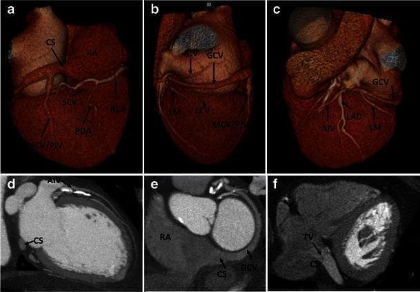 A multi-panel figure illustrating normal human coronary venous anatomy using Cardiac Computed Tomography (CCT). Panels (a-c) present 3D volume-rendered reconstructions of the heart. Panel (a) shows the posterior view, highlighting the coronary sinus (CS) in the atrioventricular groove, draining into the right atrium (RA), alongside the middle cardiac vein (MCV/PIV), small cardiac vein (SCV), and right coronary artery (RCA). Panels (b) and (c) provide anterior and lateral views, demonstrating the great cardiac vein (GCV) transitioning from the anterior interventricular vein (AIV), running parallel to the left anterior descending artery (LAD). Panels (d) and (e) are multiplanar reformat (MPR) images showing the cross-sectional relationship between the CS, the RA, and the ventricular chambers. Panel (f) is an axial CCT slice identifying the valve of Thebesius (TV) at the ostium of the coronary sinus. The collection demonstrates the spatial orientation of the cardiac venous system relative to major coronary arteries and cardiac chambers for educational use in radiology and cardiology.