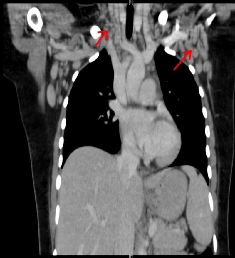 This diagnostic image is a coronal Computed Tomography (CT) scan of the human chest and lower neck, demonstrating extensive bilateral lymphadenopathy. The scan reveals multiple pathologically enlarged lymph nodes in several anatomical regions, including the cervical (neck), supraclavicular, axillary (axilla), and mediastinal compartments. The lymph nodes are characterized by their rounded or ovoid morphology and significant size increase relative to adjacent vascular and soft tissue structures. Anatomical landmarks clearly visible include the air-filled lungs (low-attenuation/dark), the central heart and mediastinal great vessels, and the thoracic skeleton including the clavicles and ribs. Red arrows are used to annotate specific clusters of enlarged nodes in the supraclavicular and axillary regions. This clinical imaging illustrates systemic lymph node involvement, which is essential for diagnosing conditions such as lymphoma, sarcoidosis, or systemic inflammatory syndromes like Hemophagocytic Lymphohistiocytosis (HLH). The imaging modality and presentation are typical for evaluating thoracic and systemic lymphadenopathy in an internal medicine or oncology context.