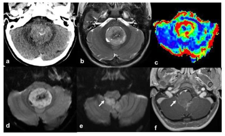 A multi-panel neuroradiological figure displaying axial views of the posterior fossa in a pediatric patient. (a) Non-contrast axial CT shows a hyperdense mass within the fourth ventricle containing focal lesional mineralizations. (b) T2-weighted MRI demonstrates the tumor's heterogeneous signal intensity and its well-circumscribed nature. (c) Arterial Spin Labeling (ASL) perfusion imaging reveals increased cerebral blood flow within the lesion, suggesting hypervascularity. (d) Diffusion-Weighted Imaging (DWI) shows high signal intensity, indicating restricted diffusivity and high cellular density. (e, f) DWI and gadolinium-enhanced T1-weighted images highlight the tumor's extension and involvement of the right foramen of Luschka (arrows), showing mild, heterogeneous contrast enhancement. The imaging features, including hyperdensity on CT, restricted diffusion, and anatomical location, are highly suggestive of medulloblastoma (specifically WNT-subgroup) occurring in the fourth ventricle. This figure illustrates key diagnostic modalities used for neuro-oncological assessment of pediatric brain tumors.