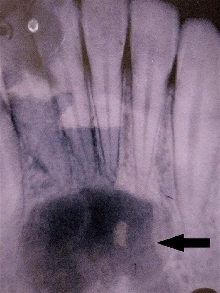 This intraoral periapical (IOPA) radiograph displays the mandibular anterior region, revealing a large, unilocular radiolucency located at the apices of the incisors and canine teeth. The lesion is characterized by a well-defined, corticated border (indicated by the black arrow), which distinguishes it from the surrounding normal trabecular bone. Centrally, the internal structure is predominantly homogenous and radiolucent, suggesting a cystic or fluid-filled cavity. Crucially, the radiograph shows that the roots of the associated teeth remain intact, with no evidence of external root resorption or significant displacement, despite being within the lesion's proximity. The finding is clinically significant for the differential diagnosis of odontogenic cysts, such as a radicular cyst (if teeth are non-vital) or a lateral periodontal cyst, and non-odontogenic lesions like a traumatic bone cyst. This image is an essential teaching tool for oral radiology, highlighting key features of benign periapical pathology including margin definition and effects on adjacent dental structures.