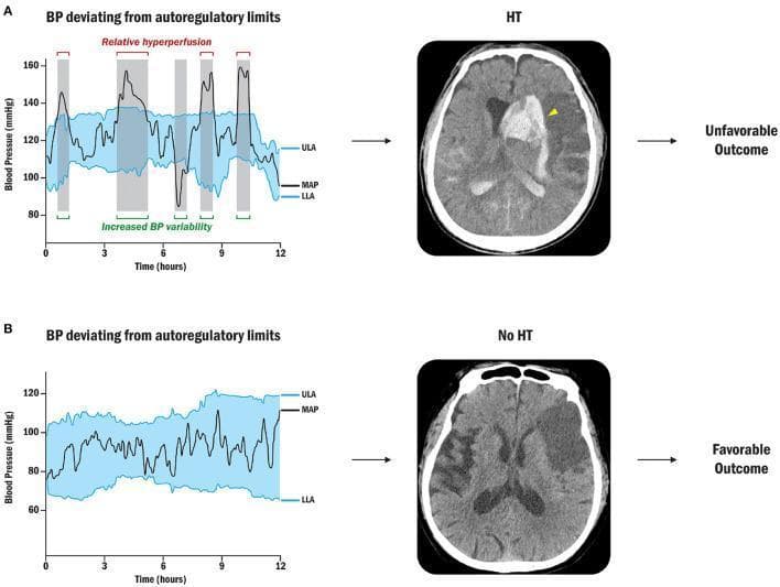 Educational infographic and diagnostic comparison illustrating the relationship between blood pressure (BP) autoregulation and hemorrhagic transformation (HT) following ischemic stroke. The visual is divided into two clinical scenarios (A and B).
Row A (Unfavorable Outcome): A line graph shows Mean Arterial Pressure (MAP) frequently deviating above the Upper Limit of Autoregulation (ULA), indicated by shaded gray vertical bars representing relative hyperperfusion. The corresponding non-contrast axial CT scan of the brain reveals a large area of hyperdensity (indicated by a yellow arrowhead) within a hypodense ischemic territory in the left hemisphere, characteristic of parenchymal hematoma or HT. There is associated mass effect and ventricular compression.
Row B (Favorable Outcome): The graph depicts MAP maintained strictly within the personalized limits of autoregulation (between ULA and LLA). The corresponding axial CT scan shows a stable, well-demarcated area of hypodensity in the left middle cerebral artery territory, representing an established infarct without evidence of hyperdense blood products (No HT).
This comparison demonstrates how maintaining cerebral perfusion pressure within autoregulatory limits can prevent secondary brain injury and improve clinical outcomes by mitigating the risk of post-stroke hemorrhage.