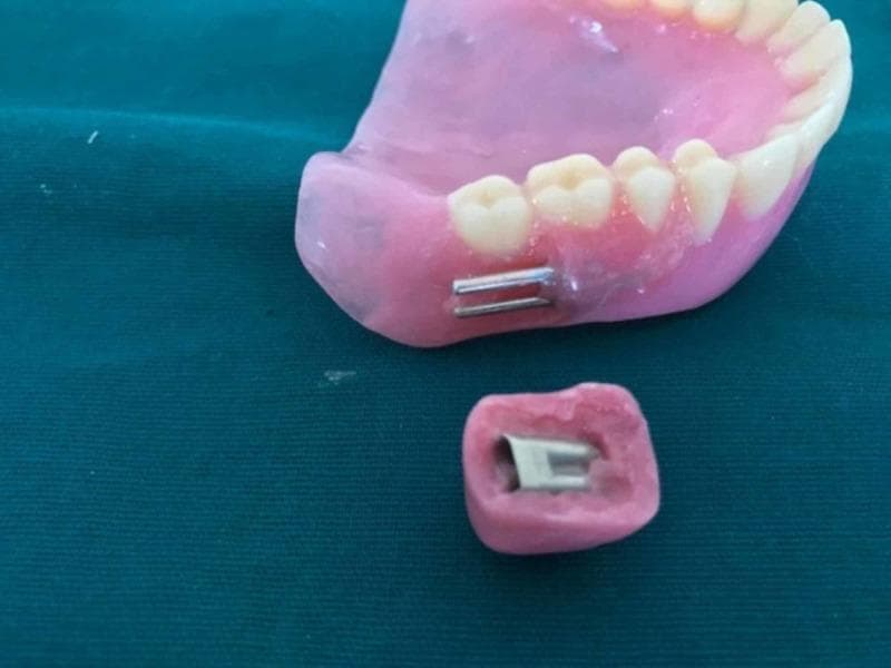 A clinical photograph of a maxillary complete denture and a separate detachable cheek plumper, illustrating a mechanical attachment system for prosthodontic rehabilitation. The denture base is constructed from pink heat-polymerized acrylic resin with anatomical artificial teeth. Positioned on the buccal flange in the molar region are two parallel, cylindrical metallic die pins that project outwards. Below the denture lies a small, matching pink acrylic cheek plumper containing an embedded metallic sleeve designed to receive the die pins. This configuration demonstrates a friction-fit, interlocking mechanism used to provide extraoral support for slumped facial musculature in patients with severe resorption or loss of dental esthetics. The image highlights the laboratory phase of prosthodontic fabrication, focusing on the precise alignment and housing of retentive elements to ensure a stable, yet removable, connection between the primary prosthesis and the cosmetic accessory.