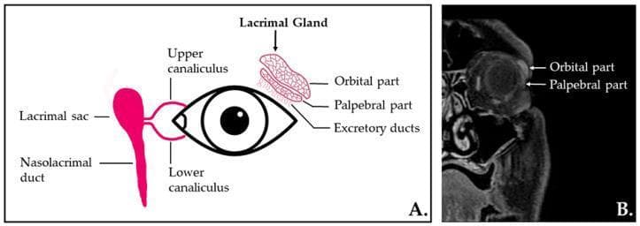 This dual-panel educational figure presents the anatomy and radiographic appearance of the human lacrimal apparatus. Panel A is an anatomical diagram illustrating the secretory and excretory components, including the almond-shaped lacrimal gland situated superolaterally to the eye, its orbital and palpebral parts, and excretory ducts. The drainage system is shown via the upper and lower canaliculi leading into the lacrimal sac and nasolacrimal duct. Panel B is a coronal, contrast-enhanced T1-weighted MR image with fat saturation of the left orbit. It demonstrates the normal radiological appearance of the lacrimal gland within the extraconal space of the superolateral orbit. The image clearly differentiates the superior orbital lobe and the inferior palpebral lobe. This material is designed for medical students and clinicians to understand the structural organization of the tear production and drainage system, which is critical for evaluating conditions like SjΓΆgren's syndrome, dacryoadenitis, or nasolacrimal duct obstruction.
