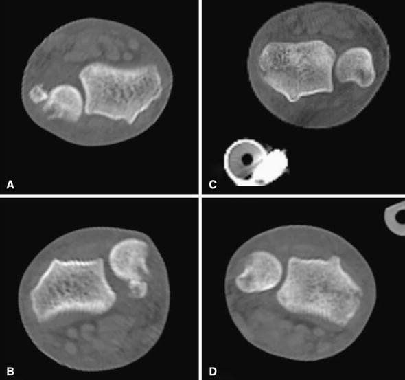 Axial plane computed tomography (CT) scans of bilateral wrists comparing the congruity of the distal radioulnar joint (DRUJ) in different forearm rotations. Figures A and B represent the right wrist in supination and pronation, respectively, demonstrating persistent dorsal subluxation of the ulnar head relative to the sigmoid notch of the radius. This finding is characteristic of an unstable DRUJ following a Galeazzi-type injury. Figures C and D show the left wrist in supination and pronation, illustrating near-normal anatomical congruity where the ulnar head remains appropriately seated within the radial notch throughout the rotational range. Image C also contains a cross-section of an external fixator pin. These diagnostic images are used to assess post-surgical stability and alignment in orthopedic trauma cases involving radius fractures with associated DRUJ disruption.