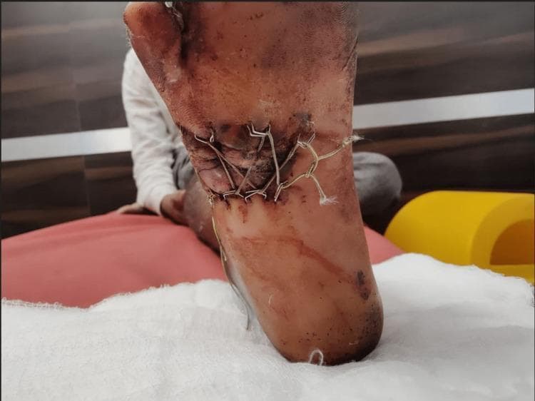 This clinical photograph shows the plantar aspect of a human foot featuring a complex wound closure. The image demonstrates the 'shoelace suture technique' applied to a large laceration. A heavy, braided suture material is woven in a criss-cross pattern across the wound bed, anchored at the margins by surgical skin staples. This tension-distributing method is used to gradually approximate wound edges in cases of significant skin loss or soft tissue trauma, such as a Gustilo-Anderson type IIIB fracture. The surrounding tissue shows signs of post-traumatic changes, including localized hyperpigmentation, bruising, and inflammatory erythema. Frayed ends of the suture material are visible at the anchoring points. The plantar skin appears thickened and exhibits some superficial abrasions. This visual serves as an educational example of advanced wound management in orthopedic trauma, specifically illustrating mechanical skin stretching combined with biological adjuncts like platelet-rich plasma (PRP) for secondary closure.
