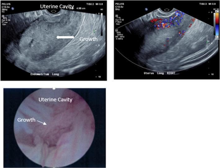 This composite medical image displays three panels illustrating diagnostic findings for endometrial adenocarcinoma in a postmenopausal patient. The top-left panel is a longitudinal grayscale transvaginal ultrasound (TVUS) showing a significantly thickened endometrium (measured at approximately 5 cm) with a heterogeneous echotexture; a white arrow indicates an irregular intraluminal growth. The top-right panel shows a color Doppler ultrasound of the same uterine area, revealing hypervascularity with prominent red and blue signals representing disorganized arterial and venous blood flow within the thickened endometrial tissue. The bottom panel is an endoscopic hysteroscopy image of the uterine cavity, providing a direct view of the lesion. It shows an irregular, raised, pinkish-tan growth with a textured, friable-appearing surface. These images collectively demonstrate the correlation between non-invasive imaging (ultrasound echogenicity and vascular mapping) and direct visualization (hysteroscopy) in the evaluation of postmenopausal bleeding and endometrial malignancy.
