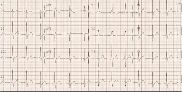 A standard 12-lead electrocardiogram (ECG) tracing printed on red grid paper, displaying a baseline rhythm consistent with Wolff-Parkinson-White (WPW) syndrome. The tracing demonstrates classic signs of ventricular pre-excitation. Key diagnostic features include a shortened PR interval and widened QRS complexes (prolonged duration) across multiple leads. Distinctive 'delta waves'—characterized by a slurred initial upstroke of the QRS complex—are clearly visible, particularly in the lateral leads (I, aVL, V5, and V6). The axis and delta wave morphology suggest an accessory pathway located in the left anterolateral region. Precordial leads show tall R waves in V1 and V2, further supporting the localization of the bypass tract. There are associated secondary ST-segment and T-wave changes opposite to the main QRS deflection, which are common in pre-excitation patterns. This ECG serves as an educational example of cardiac electrophysiology and the identification of accessory pathways in pediatric and adolescent patients presenting with supraventricular tachycardia.