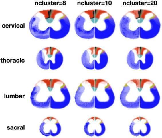 This Comparison Chart illustrates the results of region-wise automated clustering of spinal cord white matter across different levels and parcellation densities. The image is organized into a 4x3 matrix: the vertical axis represents anatomical regions (cervical, thoracic, lumbar, and sacral), while the horizontal axis indicates the number of clusters (n=8, 10, and 20). Each spinal cord cross-section is split into two halves: the left hemi-section shows data-driven clustering results color-coded to represent distinct white matter tracts based on morphometric signatures (e.g., axon density, diameter, and myelin thickness), while the right hemi-section shows the corresponding Watson atlas for reference. Notable features include the consistent delineation of the cuneate fasciculus (red) and dorsal corticospinal tract (cyan) across multiple levels. The cervical and lumbar sections show a larger cross-sectional area and more complex clustering patterns than the thoracic and sacral regions. Increasing the cluster count from 8 to 20 provides finer parcellation and reveals smaller tracts, though some regions (like the sacral level) appear noisier. This visual demonstrates the application of quantitative MRI/histology-based algorithms for neuroanatomical mapping and tractography.