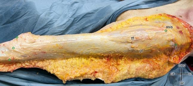 This clinical photograph of a cadaveric specimen illustrates the superficial anatomy and linear measurement of the tractus iliotibialis (iliotibial band, ITB) along the lateral aspect of the right lower limb. The dissection reveals the ITB as a dense, longitudinal band of fibrous connective tissue with a characteristic pale-tan, pearly appearance. A white measurement line extends from the proximal origin at the anterior superior iliac spine (asis) to its distal insertion on the tibia. Key anatomical landmarks visible include the tensor fasciae latae (tfl) muscle, which integrates into the proximal ITB; the iliac tubercle (it); and the greater trochanter (gt) of the femur located deep and posterior to the band. Distally, green points demarcate the tibial plateau level between the fibular head (caput fibulae) and the patellar apex. The orientation is indicated by a directional cross (medial, lateral, cranial, caudal). This image is highly relevant for surgical orthopedics, particularly regarding the Direct Anterior Approach (DAA) to the hip and understanding the biomechanics of the lateral thigh fascia.