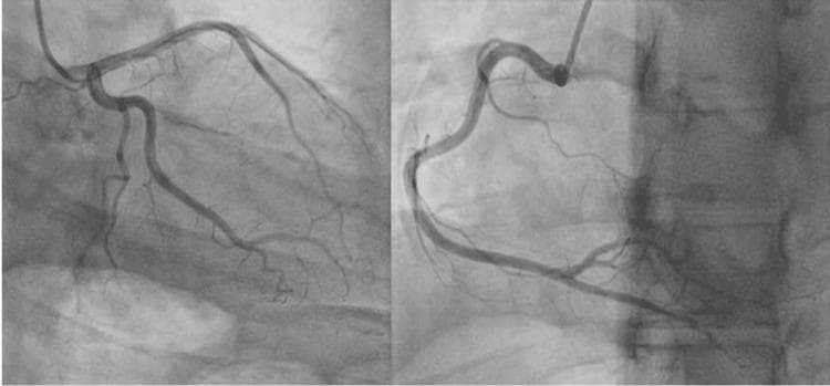 This diagnostic image consists of two side-by-side frames from a coronary angiogram (left heart catheterization). The left panel displays the left coronary artery (LCA) system, including the left main, left anterior descending (LAD), and circumflex arteries with their associated diagonal and marginal branches. The right panel demonstrates the right coronary artery (RCA) in a standard oblique projection. Both images show smooth, regular vessel calibers with well-defined margins and no evidence of significant atherosclerotic stenosis, abrupt narrowing, or filling defects. Contrast distribution is homogenous throughout the arterial tree, indicating normal flow dynamics. This visual serves as a clinical example of normal coronary anatomy in a patient presenting with cardiac symptoms (e.g., chest pain or ST-elevation), used to rule out obstructive coronary artery disease or spontaneous coronary artery dissection (SCAD) in the differential diagnosis of myopericarditis.