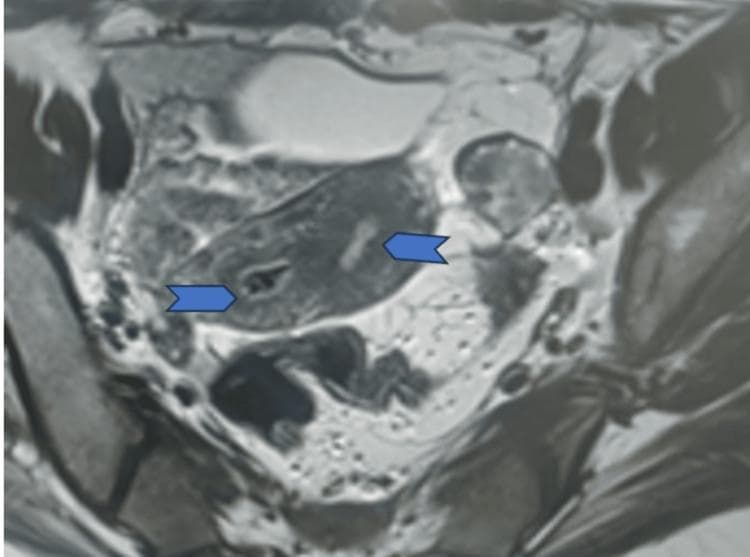 This diagnostic image is a transverse (axial) MRI section of the female pelvis, demonstrating a Müllerian duct anomaly. The scan shows a bicornuate uterus characterized by two distinct uterine horns and endometrial cavities. Blue arrowheads highlight the dual uterine cavities, which appear as two separate, low-signal intensity (hypointense) spaces within the uterine musculature. These cavities are separated by a central band of myometrial tissue of intermediate signal intensity. The external uterine contour shows a mild fundal concavity or indentation, a hallmark finding used to differentiate a bicornuate uterus from a septate uterus. Surrounding pelvic anatomy, including the iliac vessels and posterior elements, is visible but secondary to the central uterine pathology. This imaging is clinically significant for diagnosing congenital uterine malformations, which can impact reproductive outcomes and obstetric management.