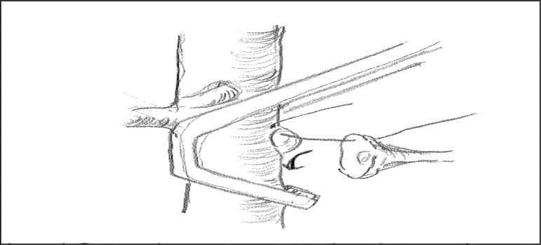 A surgical illustration depicting orthotopic renal transplantation, specifically focusing on the arterial clamping technique. The diagram shows the abdominal aorta as a central, vertical cylindrical vessel. A Satinsky surgical clamp is applied to the aorta, positioned precisely at the base of the left renal artery. This selective clamping method is designed to occlude blood flow for the creation of an anastomotic opening (approximately 8 mm from the artery base) while purposefully sparing the mesenteric arteries and the right renal artery, which are visible branching superiorly to the clamped segment. The illustration highlights the relationship between the surgical instrumentation and vascular anatomy to maintain systemic circulation and prevent lower limb or contralateral renal ischemia during the procedure. Key features include the orientation of the clamp jaws relative to the aortic wall and the positioning of the arterial suture lines for donor kidney attachment.