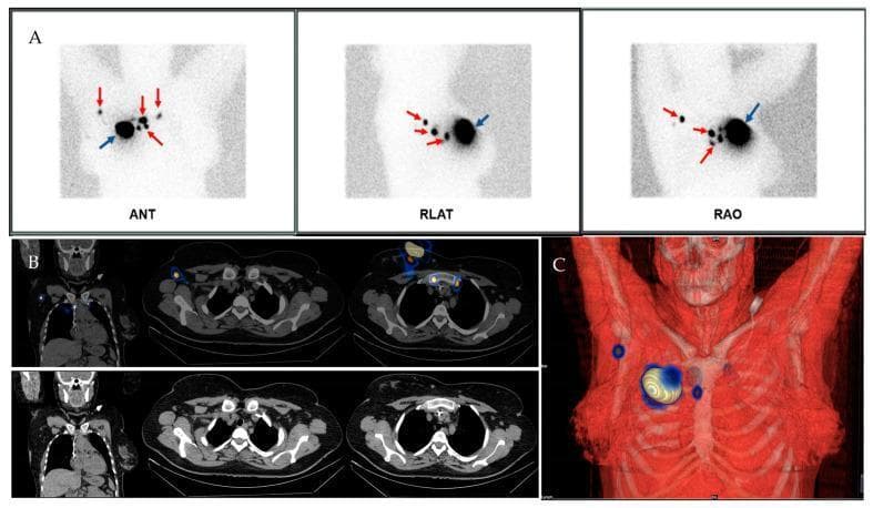 This composite diagnostic image demonstrates sentinel lymph node (SLN) mapping in a 45-year-old female patient with Stage II invasive ductal breast carcinoma. Panel A presents planar lymphoscintigraphy in anterior (ANT), right lateral (RLAT), and right anterior oblique (RAO) views. These views show a high-intensity peritumoural injection site (blue arrow) and multiple smaller, discrete spots of radiotracer uptake representing SLNs (red arrows). Panel B displays fused SPECT/CT imaging in coronal and axial planes, providing anatomical localization of the tracer uptake. This diagnostic modality identifies a complex drainage pattern involving one SLN in the right axillary region and bilateral internal mammary involvement, specifically two nodes on the right and one on the left internal mammary chain. Panel C provides a 3D volumetric rendering, illustrating the spatial relationship between the primary injection site and the lymphatic nodes relative to the thoracic skeletal structures (ribs and sternum). The combination of these modalities highlights the utility of SPECT/CT in resolving complex or ambiguous drainage patterns seen on planar imaging, crucial for precise surgical staging and biopsy planning.