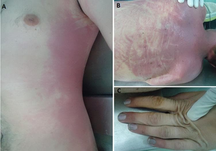 This forensic clinical photograph series documents post-mortem external examination findings in a case of carbon monoxide poisoning. Images A and B illustrate the characteristic cherry-red livor mortis (hypostasis) on the torso. Image A shows a distinct, bright pinkish-red confluent discoloration along the left lateral thoracic and abdominal regions. Image B displays a similar cherry-red distribution across the posterior aspect of the back, exhibiting a patchy, reticulated pattern where pressure from the underlying surface has caused blanched areas. These findings are pathognomonic for high levels of carboxyhemoglobin. Image C is a close-up of the right hand, showing blackish soot incrustations deposited under the fingernails and within the subungual spaces, indicative of proximity to a fire or smoke source. The skin on the dorsal aspect of the hand appears wrinkled and is being manipulated by a gloved examiner to demonstrate texture. These visual markers are critical in forensic medicine for diagnosing lethal carbon monoxide toxicity and understanding the environmental circumstances surrounding the death.