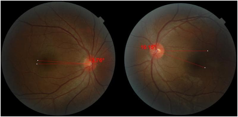 This diagnostic image consists of two side-by-side digital fundus photographs demonstrating the objective measurement of ocular torsion using the disc-foveal angle (DFA). The photographs show the posterior pole of the right (OD) and left (OS) eyes, highlighting the anatomical relationship between the optic disc and the fovea. In each frame, red annotation lines are superimposed: one horizontal line originating from the geometric center of the optic disc and a second line connecting the disc center to the fovea. In the right eye, the DFA is measured at -3.76°, indicating incyclotorsion as the fovea is positioned slightly above the horizontal plane of the optic disc. In the left eye, the DFA is 19.15°, signifying excyclotorsion with the fovea located significantly below the horizontal plane. This visual is used in ophthalmology to quantitatively assess cyclotropia, often related to superior oblique muscle palsy or other strabismus conditions, and to evaluate postoperative outcomes after muscle surgery.