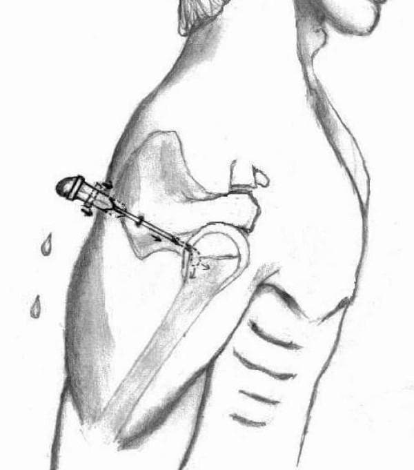 This medical illustration depicts a posterior approach for shoulder joint aspiration or injection, frequently utilized in orthopedic procedures like arthroscopy. The diagram shows a 21-gauge hypodermic needle inserted through the 'soft spot' of the posterior shoulder, located between the infraspinatus and teres minor muscles. Anatomical landmarks include the scapula with its glenoid fossa and the humeral head, forming the glenohumeral joint. A key educational feature shown is the 'hush' or 'vacuum' sign used to confirm intra-articular needle placement. The needle hub (butt) is filled with fluid, forming a convex meniscus; as the needle tip penetrates the negative-pressure environment of the glenohumeral joint, the fluid film is visualized being sucked inward, and the convexity is lost. This visual cue serves as a clinical indicator of successful entry into the joint space prior to saline distension or medication delivery.