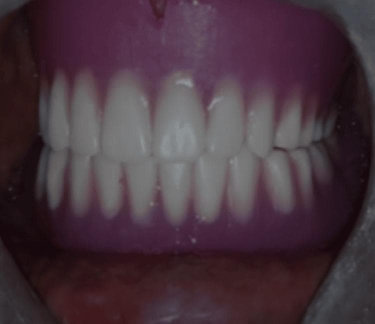 This intraoral clinical photograph depicts a set of maxillary and mandibular complete dentures in situ, demonstrating the final prosthetic outcome for an edentulous patient. The visual focus is on the occlusion and aesthetic rehabilitation. The artificial teeth are characterized by a uniform, opaque white shade and are arranged in a balanced arch form. The maxillary anterior teeth exhibit a slight vertical overlap (overbite) and horizontal overlap (overjet) relative to the mandibular teeth. The denture base is constructed from a pink heat-polymerized acrylic resin, designed to simulate natural gingival tissue and provide support via adaptation to the underlying alveolar ridges. Clinical significance includes the demonstration of proper occlusal contact and intercuspation, which are essential for masticatory efficiency and stability in prosthodontic rehabilitation, particularly in cases involving specialized impression techniques for flabby ridges.