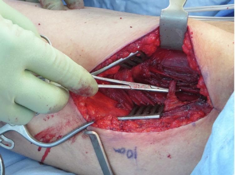 Clinical photograph of an intraoperative field during a reconstructive surgical procedure on the lower limb. The image displays a deep dissection in the medial thigh region. Two self-retaining Weitlaner retractors are positioned to maintain exposure, revealing the subcutaneous adipose tissue (yellow, lobular) and the underlying striated muscle fibers of the adductor magnus. A pair of surgical forceps, held by a gloved surgeon, is used to isolate and retract a vascular pedicle. This pedicle is shown following an atypical, total intramuscular course through the substance of the adductor magnus muscle as it travels toward the gracilis muscle. The surgical field illustrates key anatomical landmarks for free muscle transfer, specifically highlighting the neurovascular supply. Other visible instruments include a scalpel handle in the periphery. This image is used to educate on anatomical variations in vascular supply that are critical for planning soft tissue reconstructions and free flap harvest in orthopedic or plastic surgery.