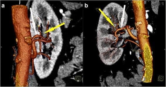 This diagnostic image set consists of three-dimensional Computed Tomography Angiography (CTA) reconstructions showcasing the vascular anatomy of the left kidney in a patient with renal pelvis carcinoma. Panel (a) provides an anterior view, and panel (b) shows a right-lateral/oblique view. The abdominal aorta is rendered in a textured brown hue, from which the renal artery originates and bifurcates into segmental branches. The kidney parenchyma is visualized in a grayscale volumetric rendering. A yellow arrow points to the tumor region located within the upper calyx of the kidney. A white arrow highlights the specific segmental arterial branch that provides the primary blood supply to this neoplastic lesion. The visualization demonstrates the precise anatomical relationship between the arterial supply and the soft tissue density in the renal pelvis, a key diagnostic feature for preoperative planning in nephron-sparing surgery. This imaging modality is essential for identifying vascular variations and ensuring targeted segmental clamping during surgical intervention for renal tumors.