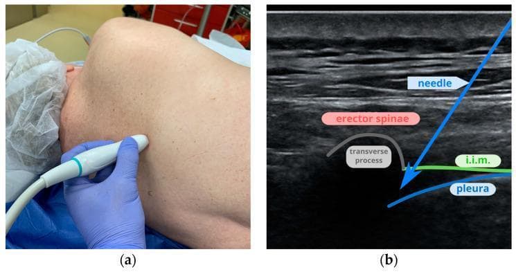 This composite image illustrates the clinical application and diagnostic visualization of an ultrasound-guided thoracic paravertebral block (PVB). Figure (a) is a clinical photograph showing the procedural setup, where a linear ultrasound probe is positioned on a patient's back between the fourth and fifth ribs. Figure (b) provides the corresponding ultrasound imaging of the thoracic anatomy. Key landmarks identified include the erector spinae muscle (visualized as a hypoechoic region superiorly), the hyperechoic curved surface of the transverse process, and the internal intercostal membrane (i.i.m.). The pleura is visible as a deeper, hyperechoic linear structure. An echogenic needle is shown in an in-plane approach, penetrating the internal intercostal membrane toward the paravertebral space. This visualization is critical for regional anesthesia in thoracic or breast surgery to ensure accurate local anesthetic deposition while avoiding pleural puncture. The educational focus is on the ultrasonographic identification of thoracic musculature and skeletal landmarks necessary for safe needle guidance.