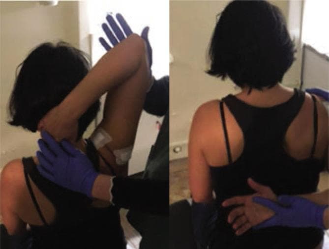 This clinical photograph consists of two panels illustrating post-procedural passive mobilization techniques for adhesive capsulitis (frozen shoulder) in a seated patient. The images demonstrate the application of physical therapy or orthopedic manipulation following glenohumeral joint hydrodistension. In the left panel, a practitioner wearing blue medical gloves performs passive abduction and external rotation; one hand supports the cervical-thoracic junction while the other guides the patient's flexed elbow and upper arm. Two white square adhesive patches, likely providing transcutaneous electrical nerve stimulation (TENS) or monitoring, are visible on the posterior-lateral deltoid region. In the right panel, the practitioner performs passive internal rotation by guiding the patient's arm into a 'hand-behind-back' position, emphasizing posterior capsule stretching. Both panels highlight the therapeutic range of motion exercises used to restore joint mobility and prevent adhesion recurrence in the shoulder complex. This clinical resource is relevant for physical medicine, rehabilitation, and orthopedic education regarding joint capsule pathologies.