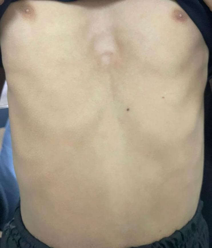 A clinical photograph of an anterior human chest demonstrating Pectus Excavatum, also known as 'funnel chest.' The image shows a notable concave depression of the sternum and lower costal cartilages. The deformity begins inferior to the nipple line and extends toward the xiphoid process, creating a sunken appearance in the central chest wall. The skin covering the area is intact with visible contours of the adjacent rib cage and minor cutaneous nevi on the upper abdominal region. This visual finding is characteristic of a congenital chest wall deformity where the breastbone sinks into the chest, which can vary in severity. The image provides an educational example of thoracic wall musculoskeletal pathology relevant to pediatrics, thoracic surgery, and physical examination training.