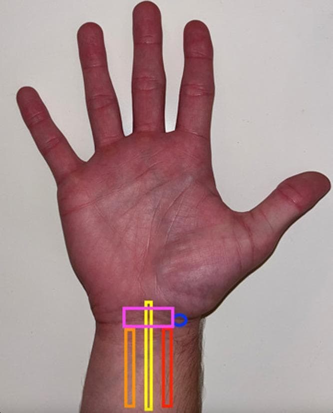 A clinical photograph of the palmar aspect of a human hand and wrist, annotated to demonstrate the surface anatomy relevant to ultrasound-guided procedures of the carpal tunnel. The image identifies key anatomical landmarks for a median nerve block. Colored overlays depict the longitudinal course of three critical structures in the distal forearm: the palmaris longus tendon (orange box), the median nerve (yellow box), and the flexor carpi radialis tendon (red box). The spatial arrangement shows the median nerve situated between the more medial palmaris longus and the more lateral flexor carpi radialis. A pink horizontal box represents the transverse placement of an ultrasound probe proximal to the wrist crease, while a blue circle indicates the optimal needle insertion site on the radial aspect. This visual aid is designed for medical education regarding regional anesthesia and the diagnosis of carpal tunnel syndrome, emphasizing the surface projection of the median nerve in relation to palpable tendons.