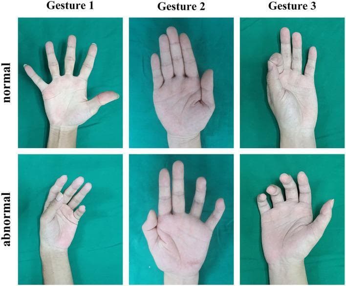 Clinical photographs depicting a comparison between normal and abnormal hand gestures used in the physical examination for peripheral nerve injuries. The image is organized in a 2x3 grid. Column 1 (Gesture 1) compares a normal fully extended and abducted hand against a 'wrist drop' or 'finger drop' appearance, typically associated with radial nerve injury. Column 2 (Gesture 2) shows a normal flat palm with fingers adducted against an abnormal posture with inability to fully extend or adduct the medial digits, often seen in ulnar nerve pathology. Column 3 (Gesture 3) demonstrates a normal 'O' sign or precision grip versus an abnormal attempt where the distal phalanges of the thumb and index finger fail to form a circle, indicative of median nerve injury (specifically anterior interosseous nerve). These images illustrate key clinical diagnostic signs including muscle weakness, atrophy, and characteristic postural deviations resulting from traumatic or compressive neuropathies of the upper limb.