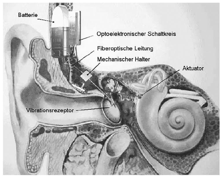 An anatomical diagram and medical device schematic illustrating a fiber-optic vibrometer system for a middle ear implant (MEI). The background shows a cross-section of the human ear, including the external auditory canal, tympanic membrane (eardrum), ossicular chain, and the cochlea in the inner ear. Superimposed on this anatomy is the implantable microphone system. Key components labeled in German include: 1) 'Batterie' (Battery) and 'Optoelektronischer Schaltkreis' (Optoelectronic circuit) positioned externally behind the pinna; 2) 'Fiberoptische Leitung' (Fiber optic line) which transmits signals transcutaneously; 3) 'Mechanischer Halter' (Mechanical holder) providing structural stability within the middle ear cavity; 4) 'Vibrationsrezeptor' (Vibration receptor) placed in contact with the ossicles to sense acoustic vibrations; and 5) 'Aktuator' (Actuator) positioned near the cochlear interface. This system functions as a contactless implantable microphone using laser interferometry or phase shift detection to drive a floating mass transducer, aiding patients with sensorineural or mixed hearing loss.