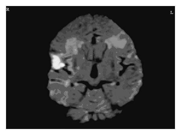 This diagnostic image is a coronal Diffusion-Weighted MRI (DWI) of the human brain. The image displays a prominent, hyperintense (bright white) region in the right frontal opercular area, indicating acute restricted diffusion. This finding is characteristic of an acute infarct, measuring approximately 3.3 x 2.6 cm. Additionally, there are bilateral areas of altered signal intensity in the inferior frontal regions, which correspond to chronic ischemic changes. The ventricular system and midline structures are visible in this section, and orientation markers 'R' and 'L' are provided to denote the anatomical right and left hemispheres. This imaging is clinically significant for diagnosing Foix-Chavany-Marie syndrome (anterior opercular syndrome) when presenting with the described clinical features of aphemia and loss of voluntary facio-pharyngo-glosso-masticatory control. It is an essential resource for neuroradiology and neurology education regarding ischemic stroke localization.