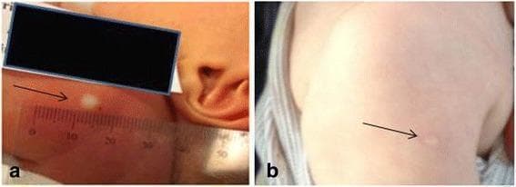 This clinical photograph set illustrates the progression of a Bacillus Calmette-Guérin (BCG) vaccination site on an infant, demonstrating the transition from an immediate skin reaction to long-term scarring. Panel (a) shows a neonatal skin reaction immediately following intradermal injection. A characteristic raised, blanched papule or 'wheal' is visible, representing the dermal deposit of the vaccine. The diameter of this wheal is being objectively measured using a transparent millimeter ruler to assess the success of the administration. Panel (b) depicts the same anatomical region—the upper left arm—at 13 months of age. It shows a definitive BCG scar, which is characterized by a round, flat, and hypopigmented area relative to the surrounding tissue. Black arrows in both panels highlight the specific site of interest. This comparison serves as an educational tool for healthcare providers to understand the correlation between the initial vaccination wheal and the subsequent development of a permanent vaccine scar, which is often used as a clinical marker of vaccination history in tuberculosis prevention programs.