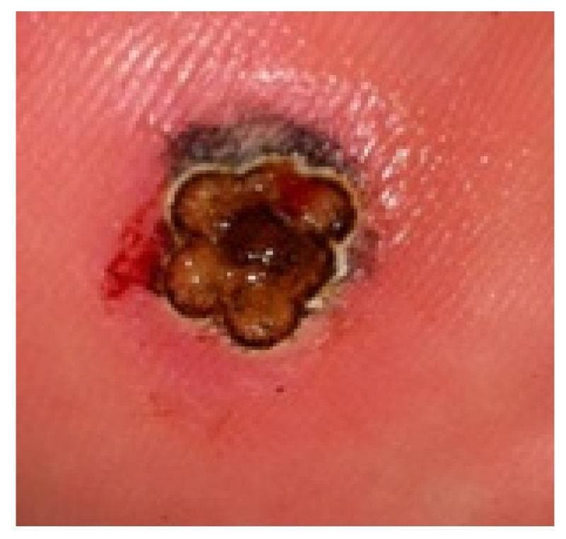 This clinical photograph displays a large plantar wart (verruca plantaris) measuring over 4 mm in diameter on the weight-bearing surface of the foot. The lesion is characterized by a raised, hyperkeratotic appearance with a clustered, multi-lobulated morphology resembling a 'mosaic' pattern. The central tissue exhibits dark brown to black discoloration, likely due to the application of India ink used in laser therapy protocols to enhance thermal absorption. A distinct, pale rim or halo surrounds the lobules, followed by a wider zone of erythematous, inflamed perilesional skin. Minor punctate bleeding is visible on the lateral margin, typical of exposed capillaries (thrombosed capillaries) following the removal of overlying hyperkeratosis. This image serves as a clinical example of a recalcitrant plantar wart prepared for laser treatment, illustrating the anatomical challenges of treating thick epidermal lesions on the plantar surface.