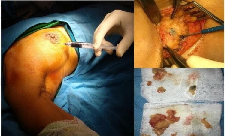 This composite of clinical photographs illustrates the sequence of a Sentinel Lymph Node Biopsy (SLNB) in a patient with breast cancer. The large left panel shows the intraoperative injection of a blue tracer dye (typically isosulfan blue or methylene blue) into the periareolar region of the breast to map lymphatic drainage. The top-right panel displays the subsequent surgical dissection in the axillary region, where retractors and forceps are used to expose adipose tissue and identify a sentinel lymph node visibly stained with the blue dye. The bottom-right panel shows the excised surgical specimens (biopsy samples) placed on sterile gauze; some fragments exhibit the blue-black pigmentation characteristic of successful dye uptake, confirming they are sentinel nodes. This educational visual demonstrates the combined technique of dye mapping, surgical localization, and node retrieval used to assess axillary nodal status and guide surgical oncology staging.