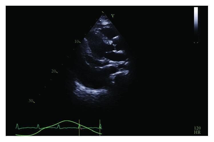 This diagnostic image is a transthoracic echocardiogram (TTE) in a parasternal long-axis view demonstrating a large, circumferential pericardial effusion. The pathology is characterized by a significant echo-lucent (dark) space surrounding the cardiac silhouette, most prominent anteriorly and posteriorly. Visible hemodynamic consequences include compression of the right ventricle, suggestive of cardiac tamponade physiology. Additionally, a large adjacent pleural effusion is noted, appearing as a separate fluid collection posterior to the descending aorta. The heart chambers show restricted diastolic filling due to the external pressure exerted by the pericardial fluid. An ECG trace at the bottom shows sinus tachycardia with a heart rate of 120 bpm, which is a common compensatory finding in patients with tamponade. This image is a classic educational example of restrictive cardiac pathology requiring urgent intervention such as a pericardial window or pericardiocentesis.