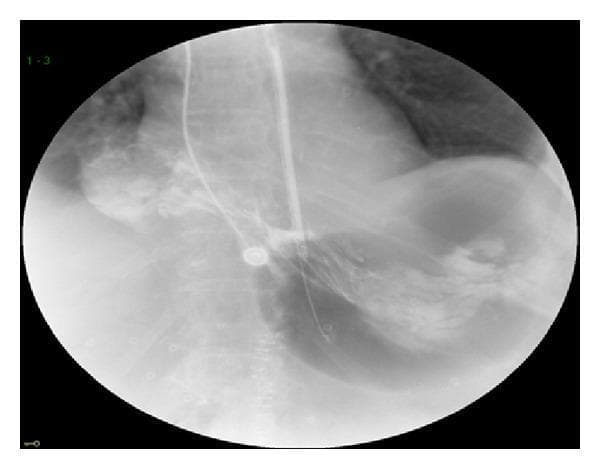 This diagnostic image is an upper gastrointestinal (GI) series using fluoroscopic radiography, demonstrating a case of gastric volvulus. The radiograph shows a nasogastric (NG) tube coursing down the esophagus and into the stomach, delivering water-soluble contrast media. Key clinical findings include a significantly distended stomach with the gastric antrum displaced superiorly into the supradiaphragmatic position, indicating an organoaxial or mesenteroaxial rotation. While the contrast fills the herniated antrum, there is a visible absence of contrast passage into the duodenum, characteristic of a high-grade obstruction or volvulus. The thoracic cavity shows a large gas-filled viscus consistent with a paraesophageal hiatal hernia. This image is an educational example of acute gastric volvulus presenting as a surgical emergency, illustrating the classic radiographic signs of abnormal gastric orientation and outflow obstruction within the mediastinum.