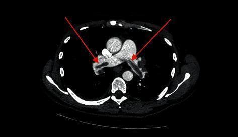 This diagnostic axial CT angiography (CTA) scan of the chest reveals a classic saddle pulmonary embolism. The primary visual finding is a large, low-attenuation filling defect centrally located at the bifurcation of the main pulmonary artery. This thrombus straddles the carina and extends into both the right and left pulmonary arteries. Two red arrows indicate the specific sites where the hypodense embolus obstructs the contrast-enhanced pulmonary vasculature. The surrounding mediastinal structures, including the ascending aorta and the superior vena cava, are visible and show normal contrast enhancement. This imaging modality is the gold standard for diagnosing acute pulmonary embolism, and the 'saddle' configuration demonstrated here indicates a massive or submassive embolic event with high clinical significance for hemodynamic instability.
