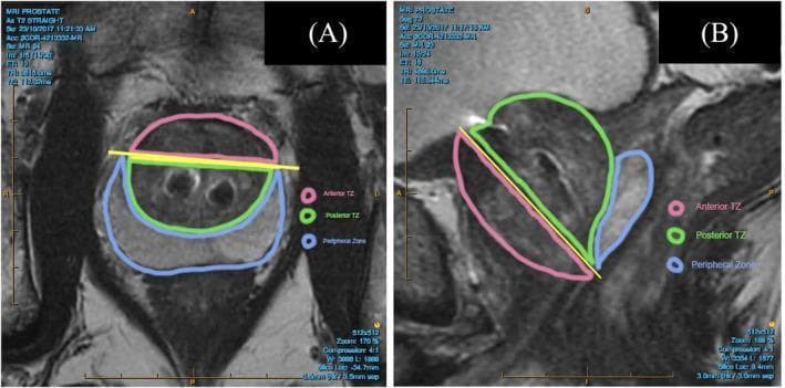 Two T2-weighted magnetic resonance imaging (MRI) scans of the human prostate gland in axial (A) and sagittal (B) planes, annotated to delineate zonal anatomy. The images highlight three distinct regions: the Anterior Transition Zone (outlined in pink), the Posterior Transition Zone (outlined in green), and the Peripheral Zone (outlined in blue). In the axial view, a yellow horizontal line marks the confluence of the peripheral and transition zones. In the sagittal view, a yellow line extends from the anterior urethra to the distal extension of the peripheral zone, acting as a boundary between the anterior and posterior transition zones. The peripheral zone is characterized by higher signal intensity (brighter appearance) compared to the transition zones. These images are used to demonstrate prostate anatomy and the spatial relationship between zones, which is critical for identifying pathology such as benign prostatic hyperplasia (BPH) and prostate cancer, or assessing metal artifacts from urethral implants.
