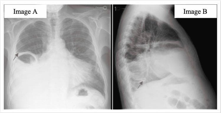 This diagnostic chest x-ray comparison consists of two panels: Image A (Posteroanterior view) and Image B (Lateral view). The imaging demonstrates a large right-sided pleural effusion. In the PA view (Image A), a dense, homogeneous opacity is visible in the lower two-thirds of the right hemithorax, obscuring the right costophrenic angle and hemidiaphragm (silhouette sign). The superior margin of the fluid exhibits a characteristic lateral upward curvature, known as the Meniscus sign (indicated by a red arrow). In the lateral view (Image B), the posterior costophrenic sulcus is obliterated, and the opacity extends anteriorly and superiorly, confirming the volume of the effusion and suggesting underlying compressive atelectasis or consolidation of the right lower lobe. The mediastinal structures show a slight shift toward the contralateral side, consistent with significant fluid accumulation. These radiographic findings are critical for diagnosing pleural space disease and guiding subsequent clinical interventions such as thoracocentesis.