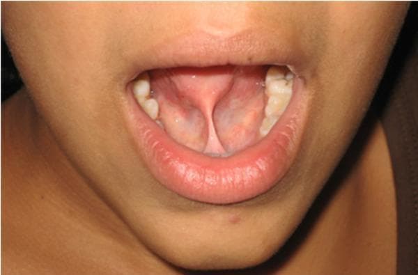 Clinical photograph of the oral cavity demonstrating ankyloglossia (tongue-tie). The image shows a short, thick, and fibrous lingual frenulum that restricts the free movement of the tongue. The frenulum attaches high on the ventral surface of the tongue, near the apex, and extends to the floor of the mouth. This tension creates a notched or 'heart-shaped' appearance of the tongue tip upon attempted protrusion or elevation. The surrounding mucosa is healthy and pink, with visible sublingual vasculature and the caruncles of the submandibular ducts located at the base of the frenulum. This presentation is consistent with a Kotlow Class III ankyloglossia, a congenital anatomical variation that can impact speech, deglutition, and oral hygiene. The photograph serves as a pre-operative assessment for a potential frenectomy.